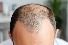 How to Help a Receding Hairline: What Actually Works